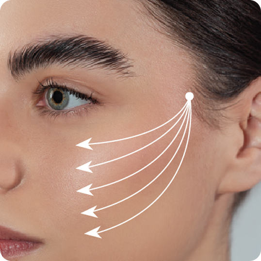 Woman's cheek in profile with white arrows indicating thread-lift directions